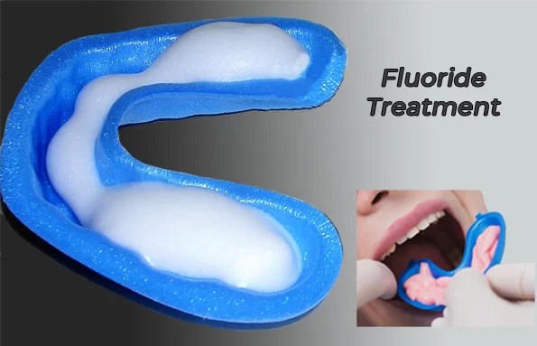 Flouride treatment
